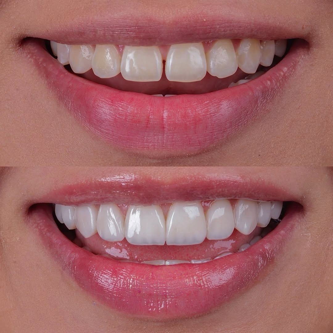 Before and after Hollywood smile transformation showing dramatically improved teeth alignment and whiteness